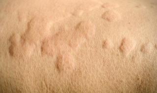 治疗慢性荨麻疹 治疗慢性荨麻疹